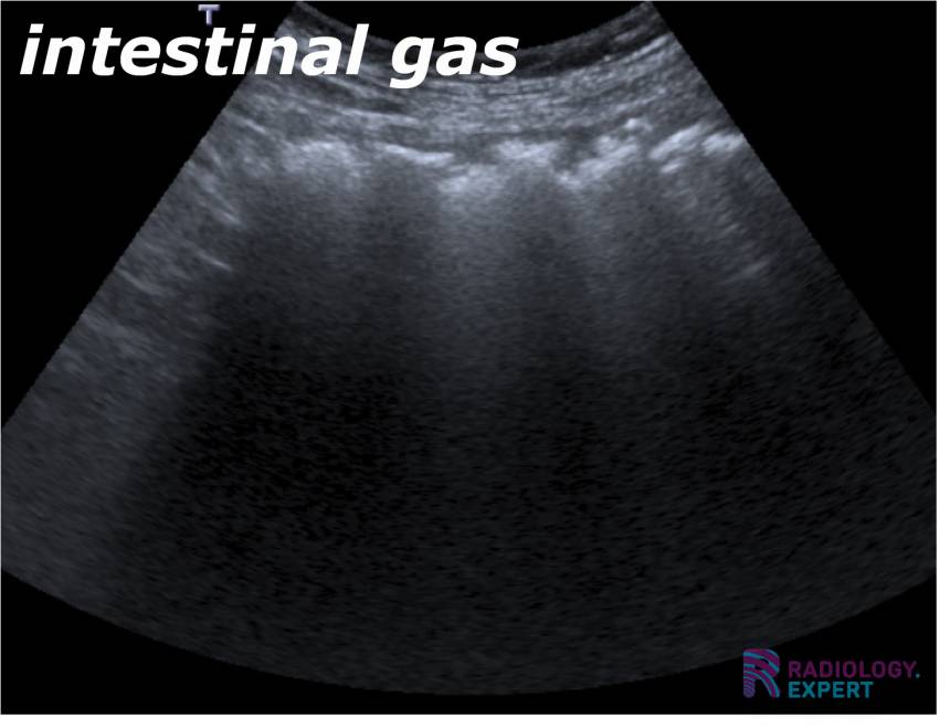 Abdominal ultrasound